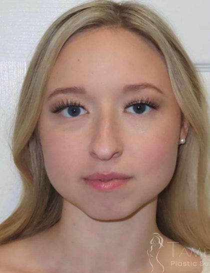 Rhinoplasty Before & After Patient #1476