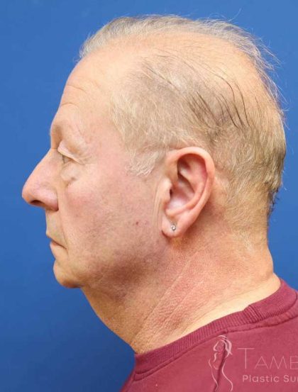 Neck Lift Before & After Patient #1487