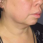 Neck Lift Before & After Patient #1498