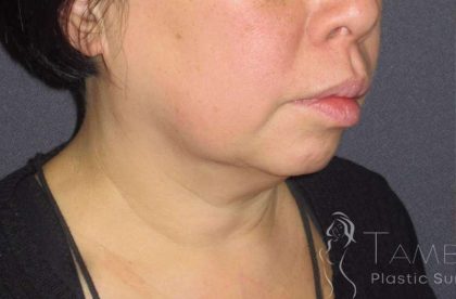 Neck Lift Before & After Patient #1498