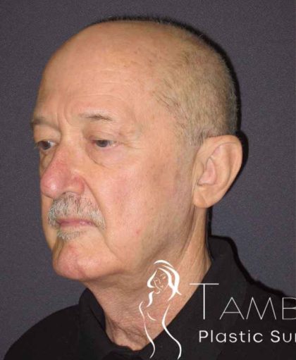 Neck Lift Before & After Patient #1509