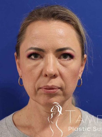 Neck Lift Before & After Patient #1538