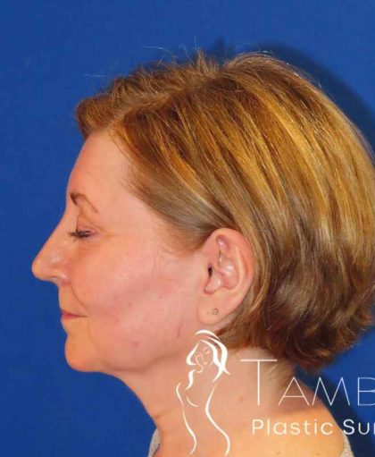 Neck Lift Before & After Patient #1549