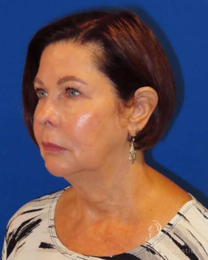 Neck Lift Before & After Patient #1578