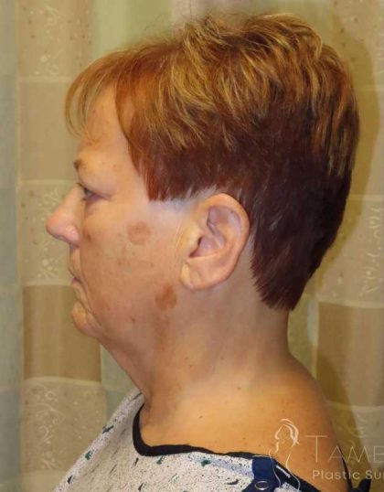 Facelift Before & After Patient #1620