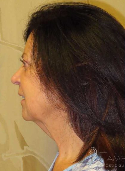 Facelift Before & After Patient #1631