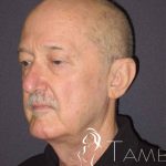 Facelift Before & After Patient #1675