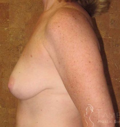 Breast Lift Before & After Patient #1856