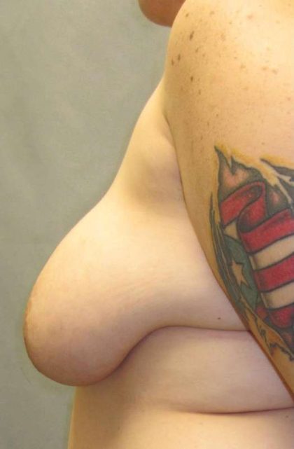 Breast Lift Before & After Patient #1891