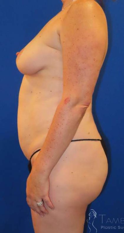 Liposuction Before & After Patient #681