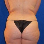 Liposuction Before & After Patient #702