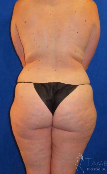 Liposuction Before & After Patient #702