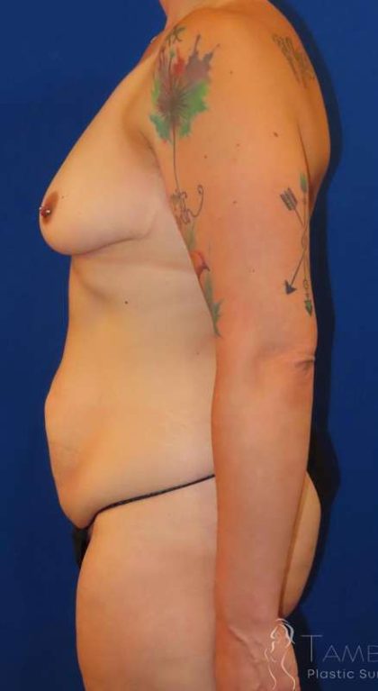 Liposuction Before & After Patient #826