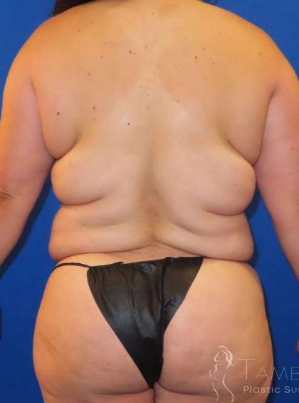 Liposuction Before & After Patient #865
