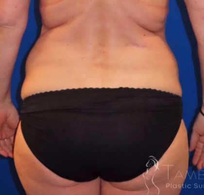 Body Contouring Before & After Patient #1065