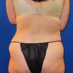 Tummy Tuck Before & After Patient #1190