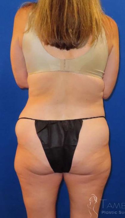 Tummy Tuck Before & After Patient #1190