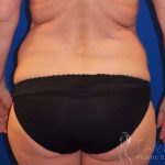Tummy Tuck Before & After Patient #1273