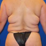 Tummy Tuck Before & After Patient #1317