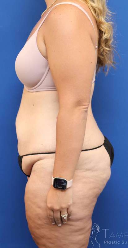 Tummy Tuck Before & After Patient #1343
