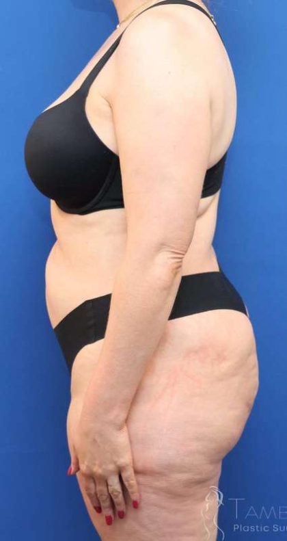 Tummy Tuck Before & After Patient #1356
