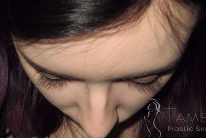 Rhinoplasty Before & After Patient #1439