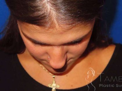Rhinoplasty Before & After Patient #1454