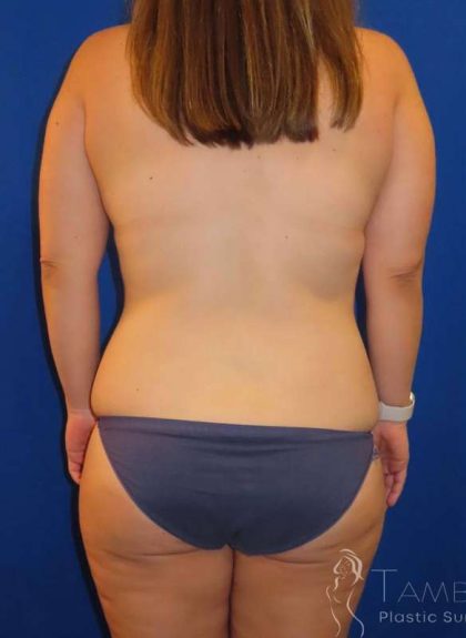 Breast Lift Before & After Patient #1869