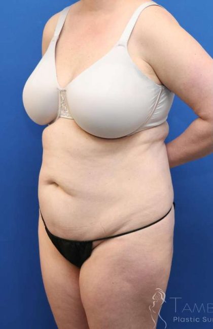 Liposuction Before & After Patient #641