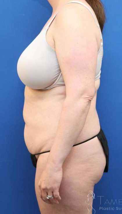 Liposuction Before & After Patient #641