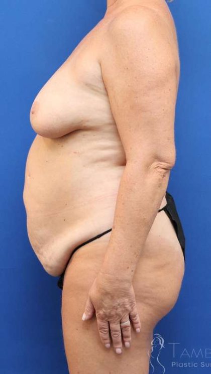 Tummy Tuck Before & After Patient #1127