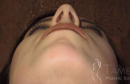 Rhinoplasty Before & After Patient #1439