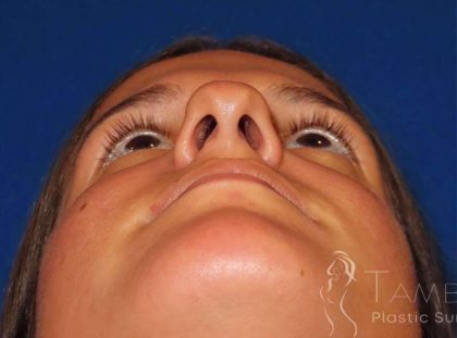 Rhinoplasty Before & After Patient #1454