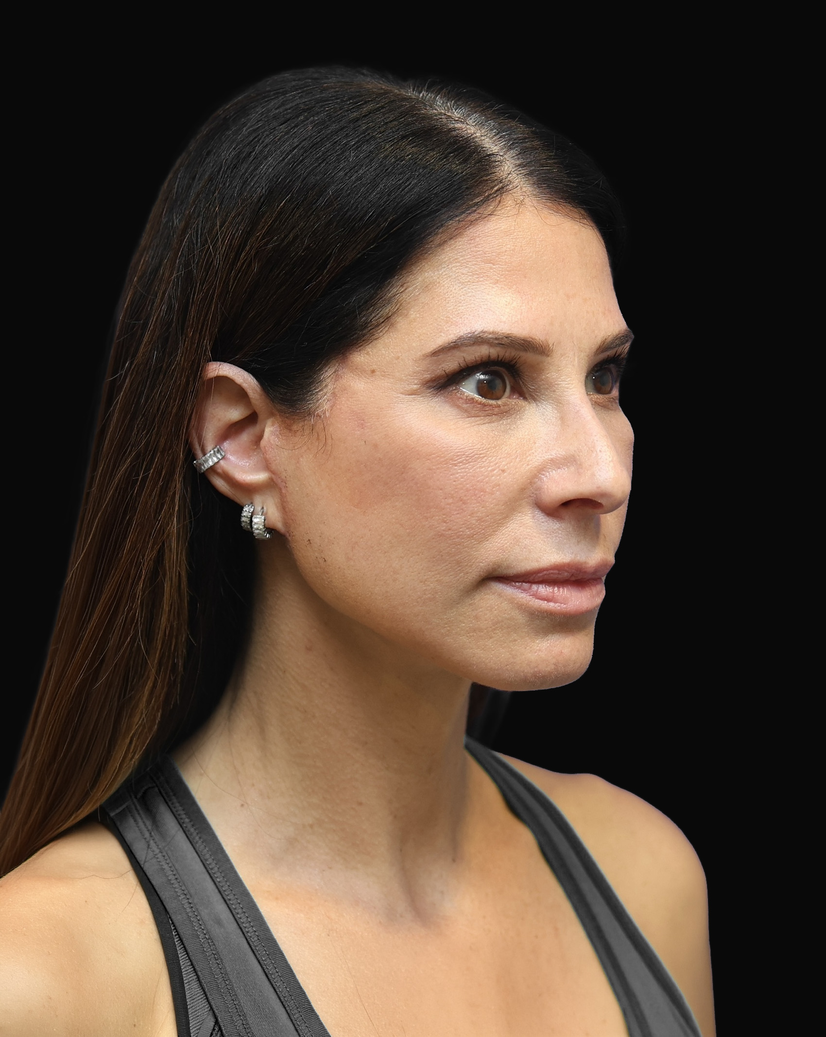 Patient photographed in three-quarter view after an extended deep plane facelift and neck lift