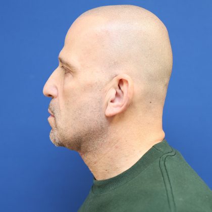 Neck Lift Before & After Patient #2990
