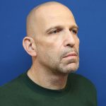 Neck Lift Before & After Patient #2990