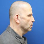 Neck Lift Before & After Patient #2990
