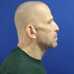 Neck Lift Before & After Patient #2990