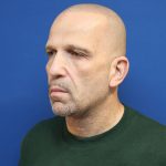 Neck Lift Before & After Patient #2990
