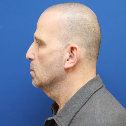 Neck Lift Before & After Patient #2990