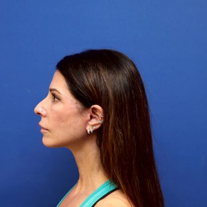 Facelift Before & After Patient #3034