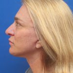 Facelift Before & After Patient #3035