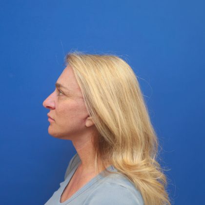 Facelift Before & After Patient #3035
