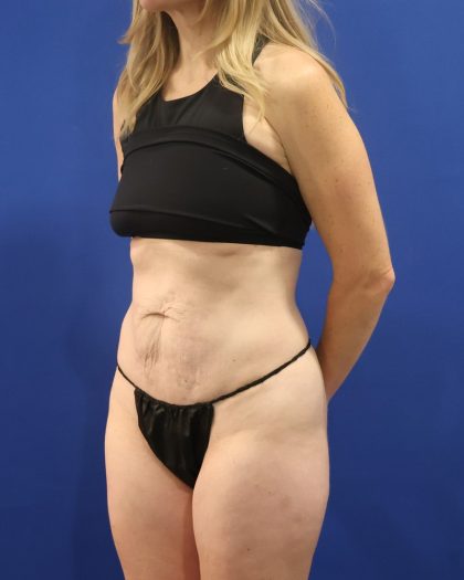 Tummy Tuck Before & After Patient #3033