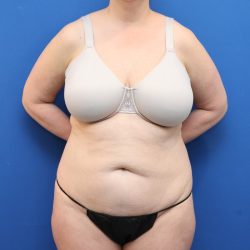 Tummy Tuck Before & After Patient #3064