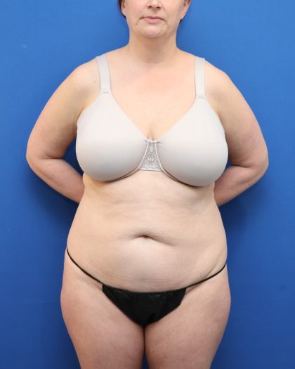 Tummy Tuck Before & After Patient #3064