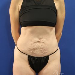 Tummy Tuck Before & After Patient #3033