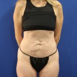 Tummy Tuck Before & After Patient #3033