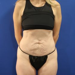 Tummy Tuck Before & After Patient #3033