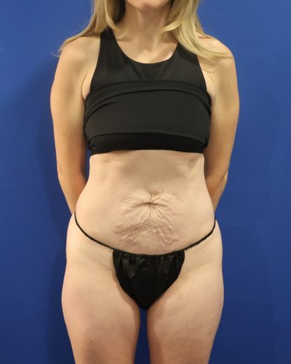 Tummy Tuck Before & After Patient #3033